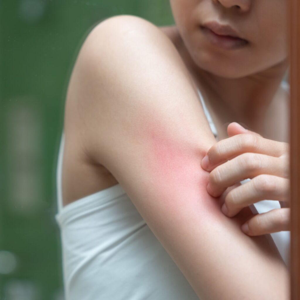 Person with red skin and rashes that itch due to incorrect or wrong sunscreen use for seborrheic dermatitis.