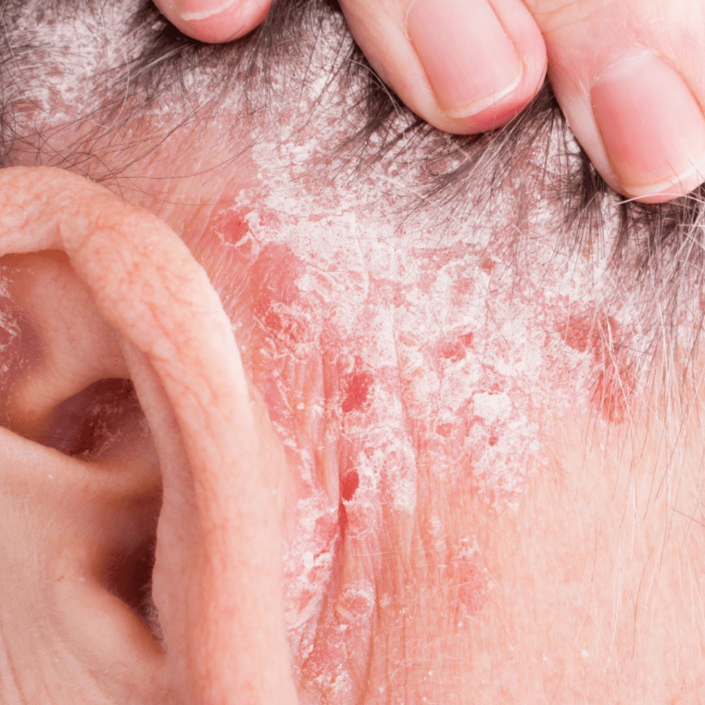 the top 10 hair conditioners for battling seborrheic dermatitis and avoiding an irritated scalp with flaky red patches